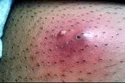 با این ترفند طلایی دیگر موهای زیرپوستی نخواهید داشت!