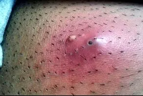 با این ترفند طلایی دیگر موهای زیرپوستی نخواهید داشت!