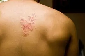 احتمال ابتلا به این بیماری بعد از تزریق واکسن کرونا