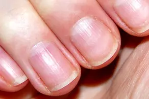 این تغییرات عجیب در ناخن نشان دهنده بیماری است!