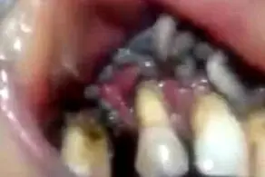 دهان چندش آور و پر از کرم زنده این زن بیچاره! +عکس