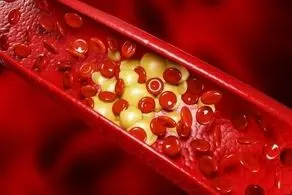 این علائم به شما می‌گوید چربی خون دارید