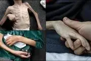 چه تعداد در غزه به دلیل سوء تغذیه به شهادت رسیدند؟ 