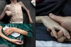 چه تعداد در غزه به دلیل سوء تغذیه به شهادت رسیدند؟ 