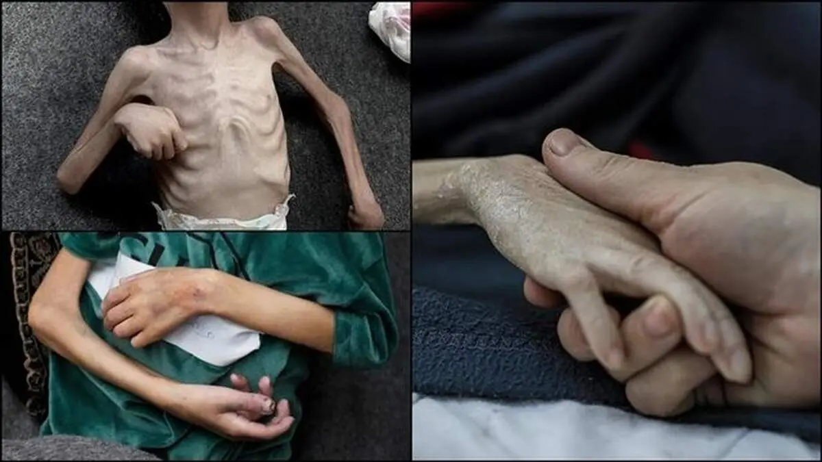 چه تعداد در غزه به دلیل سوء تغذیه به شهادت رسیدند؟ 