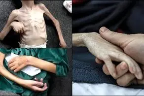 چه تعداد در غزه به دلیل سوء تغذیه به شهادت رسیدند؟ 