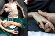 چه تعداد در غزه به دلیل سوء تغذیه به شهادت رسیدند؟ 