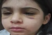 جزئیات جدید از شکنجه دختر بچه 9 ساله توسط نامادری/  وقتی دختربچه نان و رب را نخورده با گوشتکوب سه بار به سرش ضربه زده و..