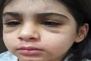 جزئیات جدید از شکنجه دختر بچه 9 ساله توسط نامادری/  وقتی دختربچه نان و رب را نخورده با گوشتکوب سه بار به سرش ضربه زده و..