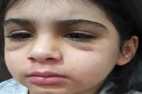 جزئیات جدید از شکنجه دختر بچه 9 ساله توسط نامادری/  وقتی دختربچه نان و رب را نخورده با گوشتکوب سه بار به سرش ضربه زده و..