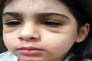 جزئیات جدید از شکنجه دختر بچه 9 ساله توسط نامادری/  وقتی دختربچه نان و رب را نخورده با گوشتکوب سه بار به سرش ضربه زده و..