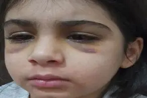 جزئیات جدید از شکنجه دختر بچه 9 ساله توسط نامادری/  وقتی دختربچه نان و رب را نخورده با گوشتکوب سه بار به سرش ضربه زده و..