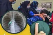 خارج کردن سوزن بزرگ از مجرای تنفسی کودک 9 ساله در بندرعباس!