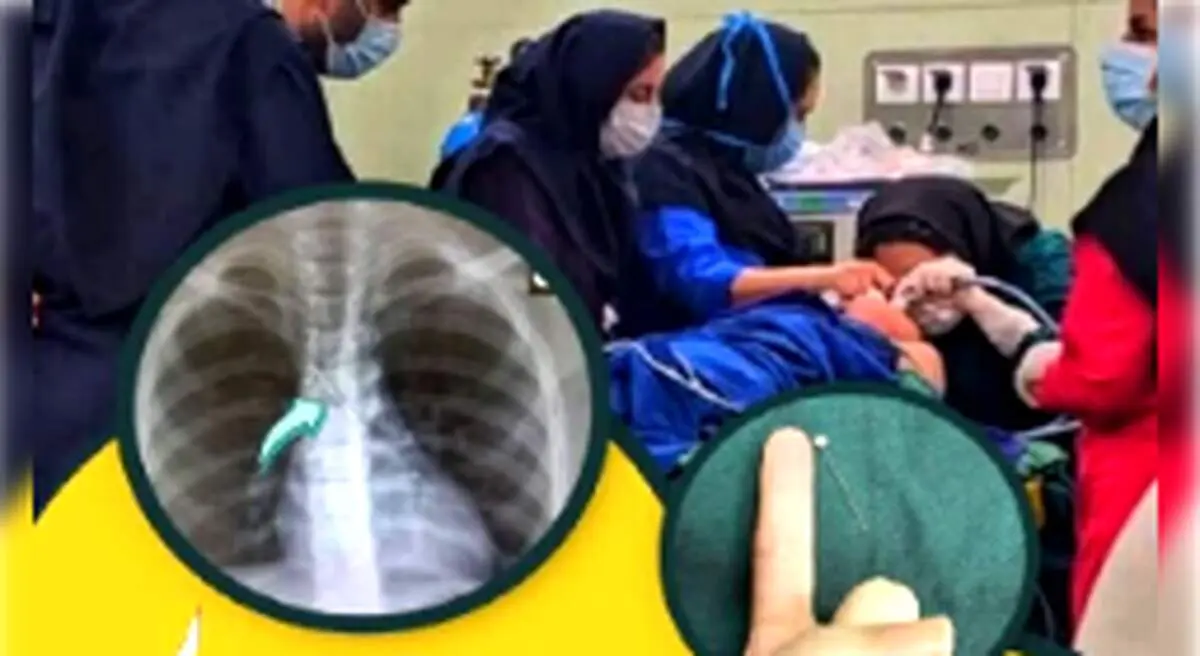 خارج کردن سوزن بزرگ از مجرای تنفسی کودک 9 ساله در بندرعباس!