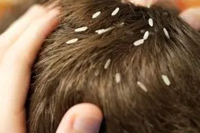 از موهای این دختر بیچاره شپش می‌چکد! +عکس