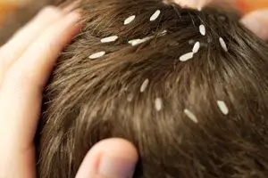 از موهای این دختر بیچاره شپش می‌چکد! +عکس