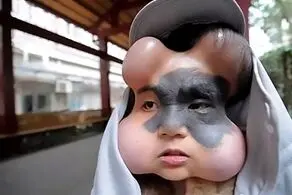 تغیر هولناک و ترسناک چهره دختر بیچاره بخاطر خال مادرزادی+ عکس