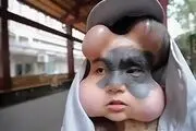 تغیر هولناک و ترسناک چهره دختر بیچاره بخاطر خال مادرزادی+ عکس