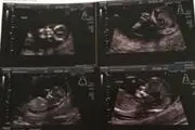 شوکه شدن مادر از حضور یه روح در عکس سونوگرافی جنین داخل شکمش!+عکس