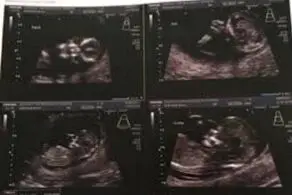 شوکه شدن مادر از حضور یه روح در عکس سونوگرافی جنین داخل شکمش!+عکس