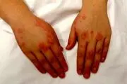 بیماری لوپوس بیشتر در کمین زنان است