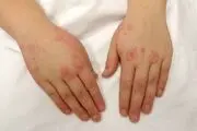 بیماری لوپوس بیشتر در کمین زنان است