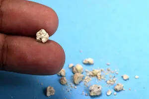 این علائم می‌گوید شما سنگ کلیه دارید!