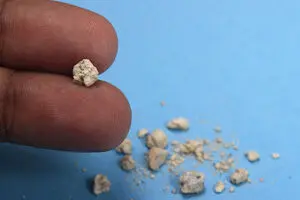 این علائم می‌گوید شما سنگ کلیه دارید!