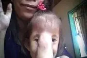 ببینید این دختر صورت هیولایی بعد جراحی چه شکلی شد/ عکس