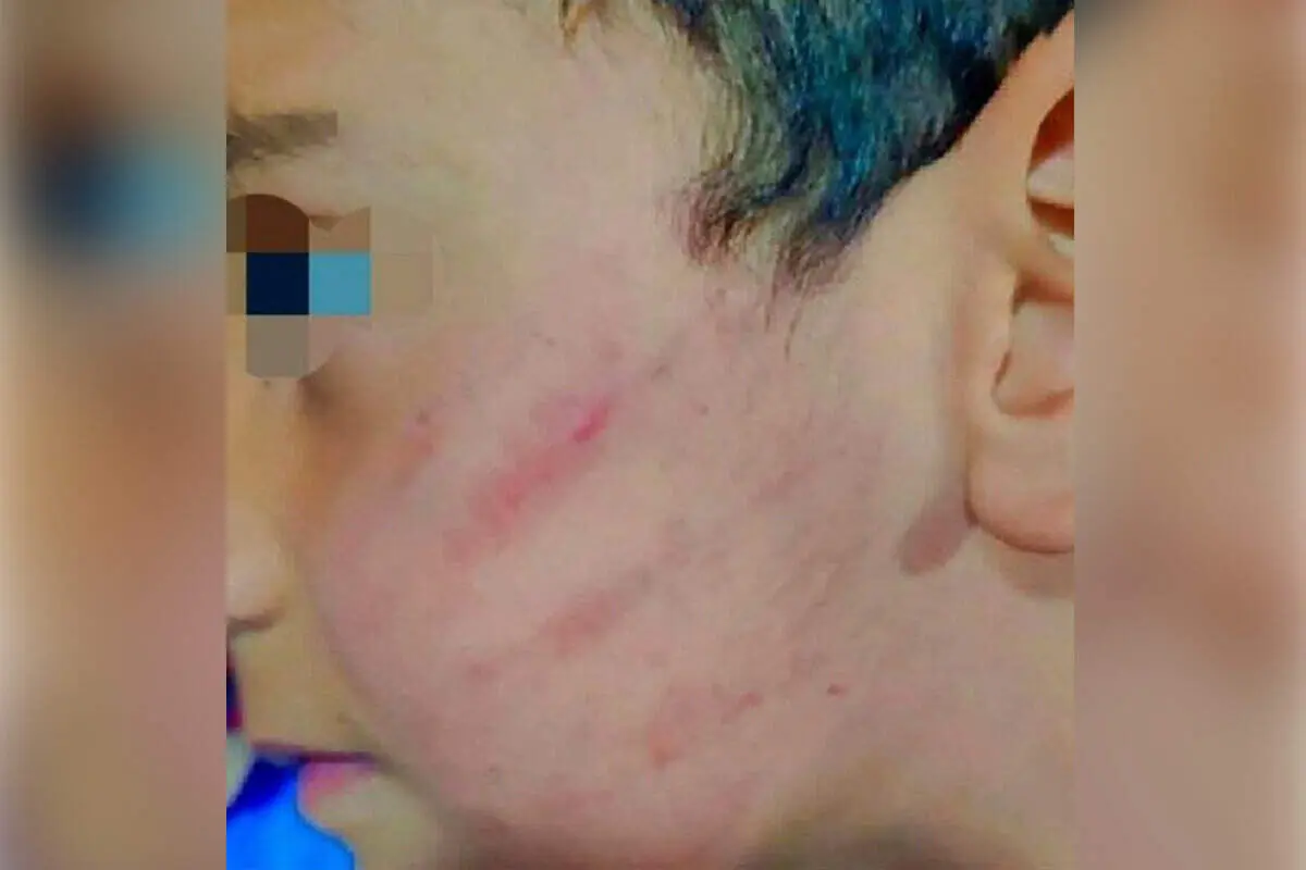 عکس دردناک از یک دانش آموز کلاس اول که در سیستان و بلوچستان کتک خورد + ببینید 