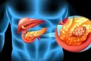 سرطان پانکراس در بدن شما ریشه دوانده اگر این علایم را دارید!