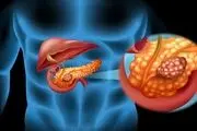 سرطان پانکراس در بدن شما ریشه دوانده اگر این علایم را دارید!