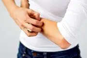 خارشی که به شما می‌گوید اوضاع کبدتان  وخیم است!


