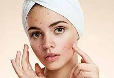 برای خلاص شدن از جوش‌های صورت چه بخوریم؟