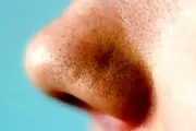 تصویری وحشتناک از محتویات بینی یک مرد