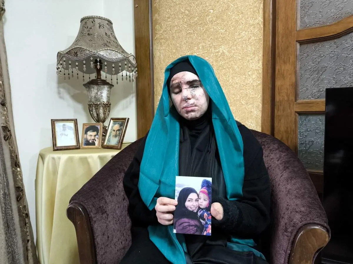 عکس +16 از زنی که در عملیات تروریستی پیجرها چشم و دستش را از دست داد + ببینید