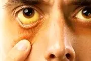 تیروئید چشمی چه نشانه‌های دارد؟