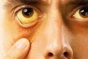 تیروئید چشمی چه نشانه‌های دارد؟