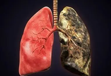  درمان سرطان ریه پیدا شد