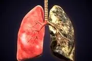 نشانه‌های اولیه سرطان ریه که نباید نادیده بگیرید