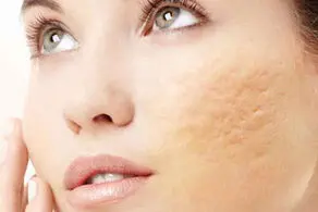یک شبه جای جوش را درمان کنید