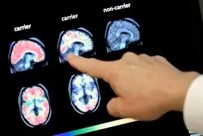 آمریکا بعد از 20 سال استفاده از این داروی مهم را تایید کرد
