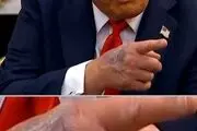 راز کبودی دست ترامپ فاش شد