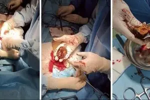 ماجرای وحشتناک «خرمالو» در اتاق‌های عمل!