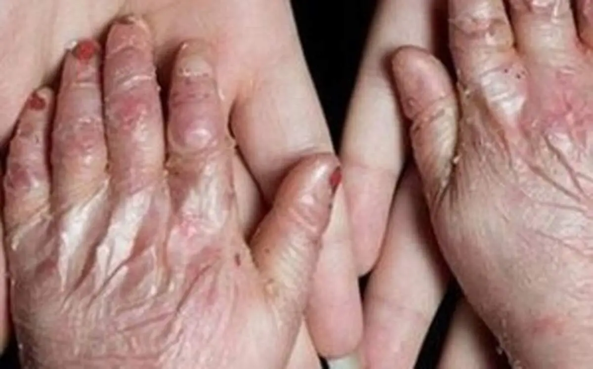 دولت آمریکا به پرداخت ۷ میلیارد دلار به بیماران پروانه ای محکوم شد