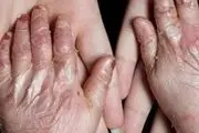 دولت آمریکا به پرداخت ۷ میلیارد دلار به بیماران پروانه ای محکوم شد