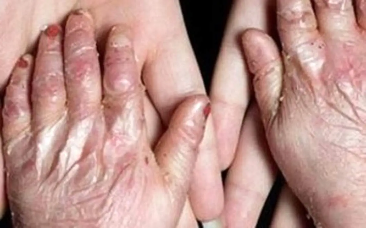 دولت آمریکا به پرداخت ۷ میلیارد دلار به بیماران پروانه ای محکوم شد