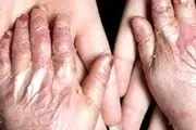 دولت آمریکا به پرداخت ۷ میلیارد دلار به بیماران پروانه ای محکوم شد