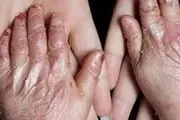 دولت آمریکا به پرداخت ۷ میلیارد دلار به بیماران پروانه ای محکوم شد
