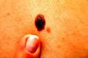 خال‌های سرطانی چه علایم هشدار دهنده‎ای دارند؟
